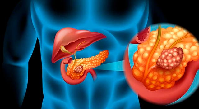 Los tratamientos basados en células T y las vacunas podrían ofrecer una alternativa más eficaz frente al cáncer de páncreas en los próximos años. Los tratamientos basados en células T y las vacunas podrían ofrecer una alternativa más eficaz frente al cáncer de páncreas en los próximos años.