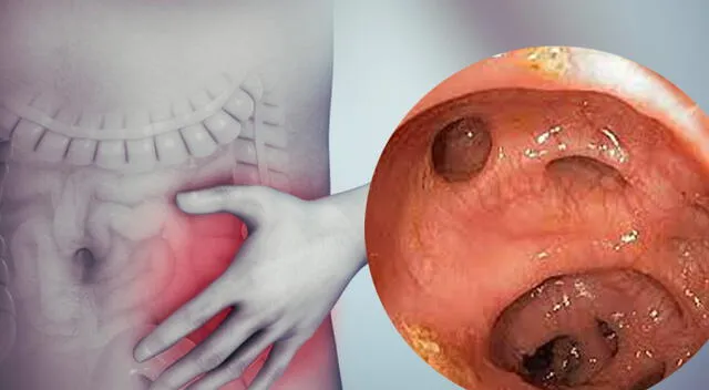 Los divertículos en el colon son una condición frecuente que afecta especialmente a la población occidental. Los divertículos en el colon son una condición frecuente que afecta especialmente a la población occidental.