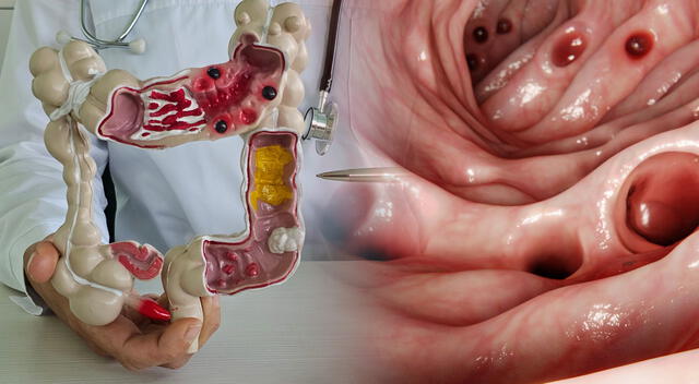 La diverticulosis generalmente no requiere tratamiento si no presenta síntomas. La diverticulosis generalmente no requiere tratamiento si no presenta síntomas.
