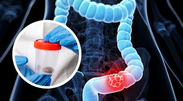 Los especialistas coinciden en que el cáncer de colon se puede prevenir en gran medida con una detección precoz y cambios en el estilo de vida. Los especialistas coinciden en que el cáncer de colon se puede prevenir en gran medida con una detección precoz y cambios en el estilo de vida.