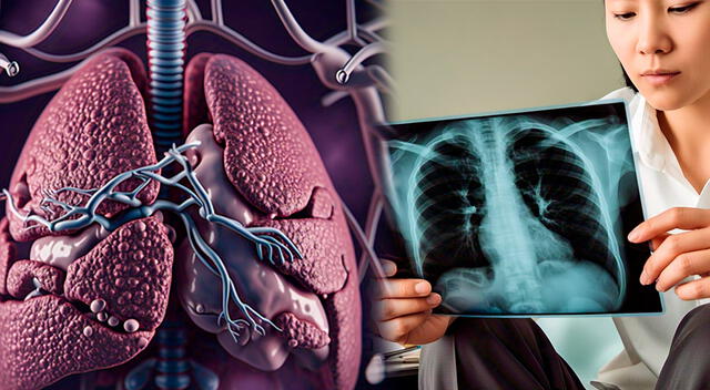 Se espera diseñar nuevas técnicas para la prevención, diagnóstico y tratamiento del cáncer de pulmón. Se espera diseñar nuevas técnicas para la prevención, diagnóstico y tratamiento del cáncer de pulmón.