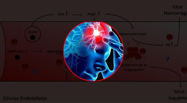 Aprende a diferenciar entre ictus isquémico e ictus hemorrágico. Foto: composición GLR/difusión Aprende a diferenciar entre ictus isquémico e ictus hemorrágico. Foto: composición GLR/difusión