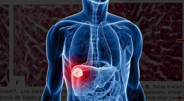 El tratamiento del cáncer de hígado depende del estadio del tumor. El tratamiento del cáncer de hígado depende del estadio del tumor.