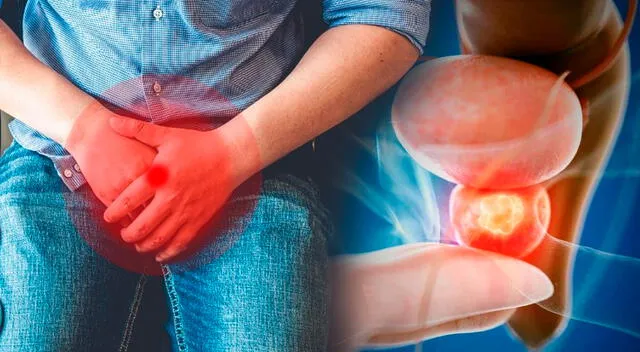 El cáncer de próstata es una enfermedad que se origina en la glándula prostática, ubicada debajo de la vejiga y frente al recto. El cáncer de próstata es una enfermedad que se origina en la glándula prostática, ubicada debajo de la vejiga y frente al recto.