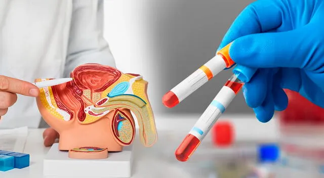La principal prueba para detectar el cáncer de próstata es el análisis de sangre. La principal prueba para detectar el cáncer de próstata es el análisis de sangre.