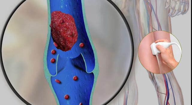 Conoce las consecuencias de los problemas de circulación de la sangre. Foto: composición GLR/difusión Conoce las consecuencias de los problemas de circulación de la sangre. Foto: composición GLR/difusión
