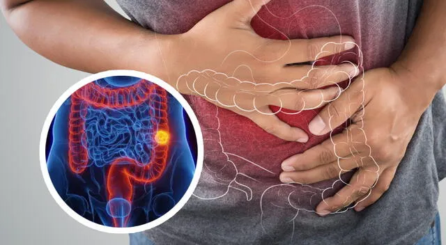 El estudio destaca la importancia de considerar la exposición a la colibactina en la infancia como un factor de riesgo en la prevención del cáncer colorrectal. El estudio destaca la importancia de considerar la exposición a la colibactina en la infancia como un factor de riesgo en la prevención del cáncer colorrectal.
