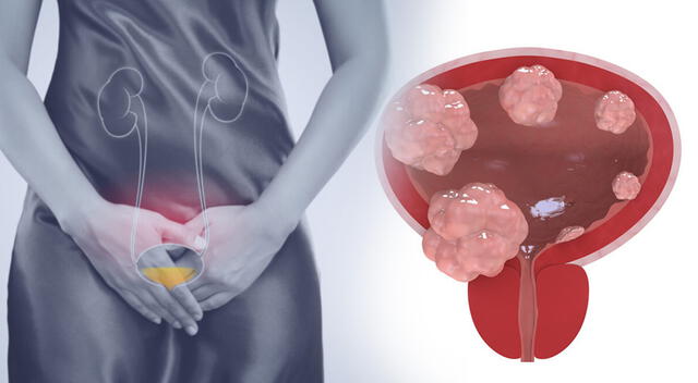 El uso de nanorrobots en el tratamiento del cáncer de vejiga es una innovación médica que, tras resultados preclínicos prometedores, se probará en humanos para confirmar su eficacia y seguridad. El uso de nanorrobots en el tratamiento del cáncer de vejiga es una innovación médica que, tras resultados preclínicos prometedores, se probará en humanos para confirmar su eficacia y seguridad.