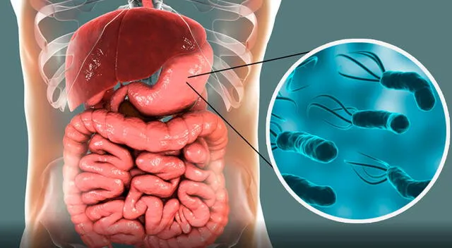 La Helicobacter pylori es una de las infecciones más comunes del planeta. La Helicobacter pylori es una de las infecciones más comunes del planeta.