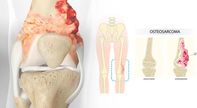 El osteosarcoma es un tipo de cáncer óseo primario y agresivo que afecta mayormente a niños, adolescentes y adultos jóvenes. El osteosarcoma es un tipo de cáncer óseo primario y agresivo que afecta mayormente a niños, adolescentes y adultos jóvenes.