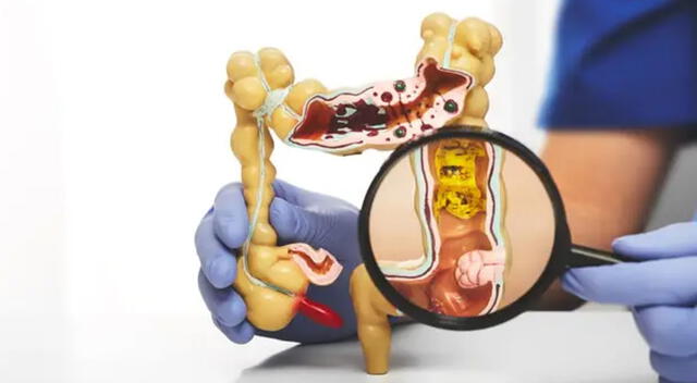 Cuando los divertículos se inflaman o infectan, aparece la diverticulitis, que puede requerir antibióticos, reposo digestivo e incluso cirugía en casos graves. Cuando los divertículos se inflaman o infectan, aparece la diverticulitis, que puede requerir antibióticos, reposo digestivo e incluso cirugía en casos graves.