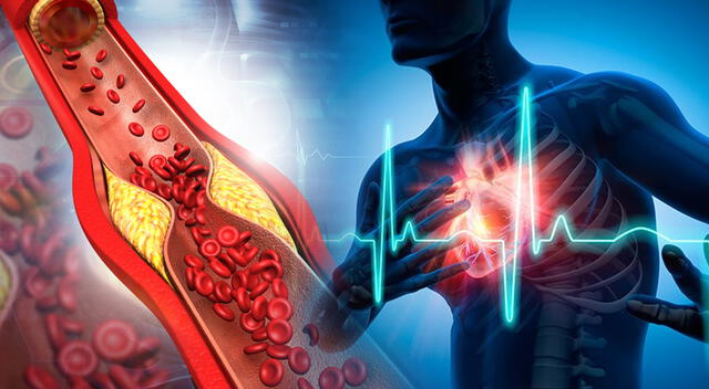 El colesterol “malo” (LDL) puede acumularse en las arterias, aumentando el riesgo de infartos y accidentes cerebrovasculares. El colesterol “malo” (LDL) puede acumularse en las arterias, aumentando el riesgo de infartos y accidentes cerebrovasculares.