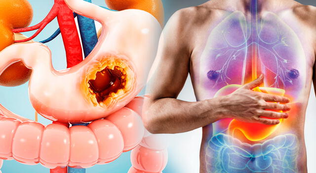 La endoscopía digestiva es clave para el diagnóstico temprano del cáncer de estómago, especialmente en personas con antecedentes familiares o síntomas persistentes. La endoscopía digestiva es clave para el diagnóstico temprano del cáncer de estómago, especialmente en personas con antecedentes familiares o síntomas persistentes.