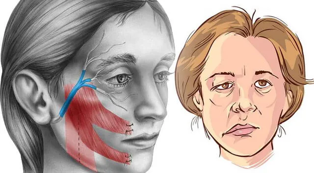 La parálisis facial puede afectar la movilidad de un solo lado del rostro, dificultando gestos simples como sonreír o parpadear. La parálisis facial puede afectar la movilidad de un solo lado del rostro, dificultando gestos simples como sonreír o parpadear.