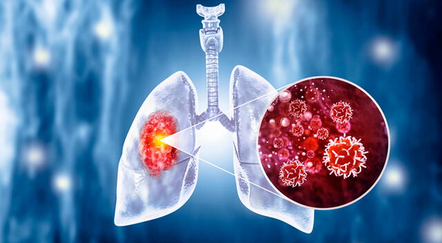 El cáncer de pulmón es uno de los más agresivos y difíciles de detectar en etapas tempranas. El cáncer de pulmón es uno de los más agresivos y difíciles de detectar en etapas tempranas.