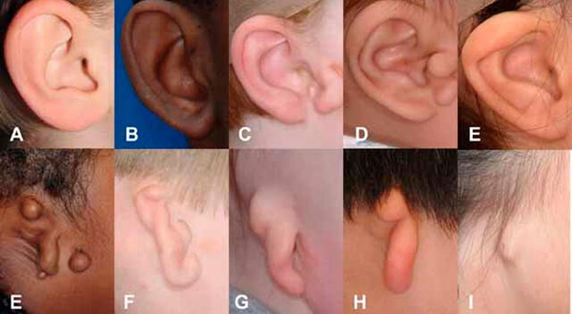 La microtia puede afectar una o ambas orejas, y su severidad varía desde una forma leve hasta la ausencia total del pabellón auditivo. La microtia puede afectar una o ambas orejas, y su severidad varía desde una forma leve hasta la ausencia total del pabellón auditivo.