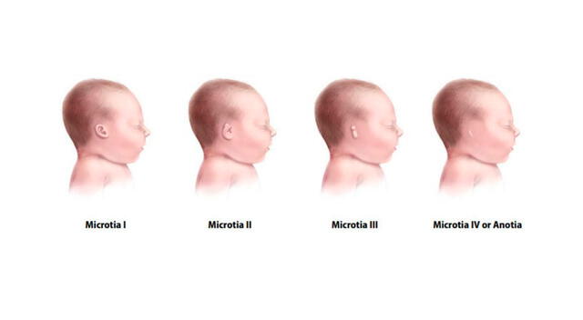 La cirugía reconstructiva es una de las opciones de tratamiento para mejorar la apariencia y función auditiva en niños con microtia. La cirugía reconstructiva es una de las opciones de tratamiento para mejorar la apariencia y función auditiva en niños con microtia.