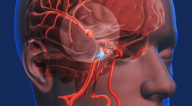 Los síntomas de un derrame cerebral pueden comenzar de forma sutil. Estar atentos a las señales del cuerpo es fundamental para actuar a tiempo. Los síntomas de un derrame cerebral pueden comenzar de forma sutil. Estar atentos a las señales del cuerpo es fundamental para actuar a tiempo.