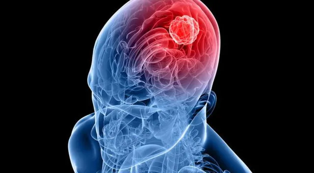 Los tumores en el cerebro pueden generar presión intracraneal y episodios de dolor de cabeza intenso que simulan una migraña Los tumores en el cerebro pueden generar presión intracraneal y episodios de dolor de cabeza intenso que simulan una migraña