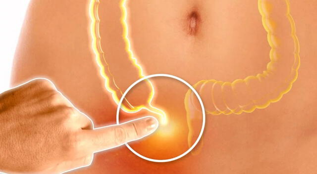 Detectar a tiempo el cáncer de apéndice puede marcar la diferencia en el tratamiento. Detectar a tiempo el cáncer de apéndice puede marcar la diferencia en el tratamiento.