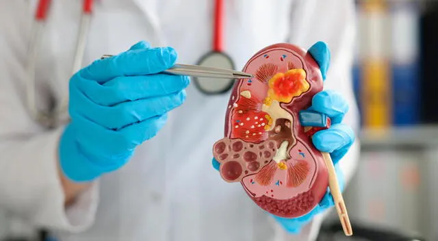 Uno de los mayores retos del cáncer renal es su carácter silencioso. Uno de los mayores retos del cáncer renal es su carácter silencioso.