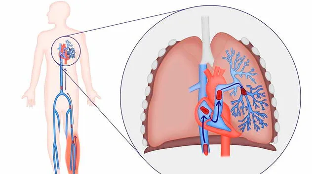 El tromboembolismo pulmonar ocurre cuando un coágulo bloquea una arteria en los pulmones, impidiendo el flujo normal de sangre y oxígeno. El tromboembolismo pulmonar ocurre cuando un coágulo bloquea una arteria en los pulmones, impidiendo el flujo normal de sangre y oxígeno.