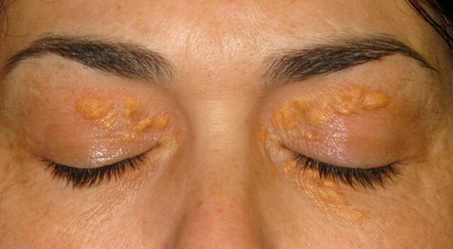 Los xantelasmas, manchas amarillentas alrededor de los ojos, son una señal visible de colesterol elevado en sangre. Los xantelasmas, manchas amarillentas alrededor de los ojos, son una señal visible de colesterol elevado en sangre.