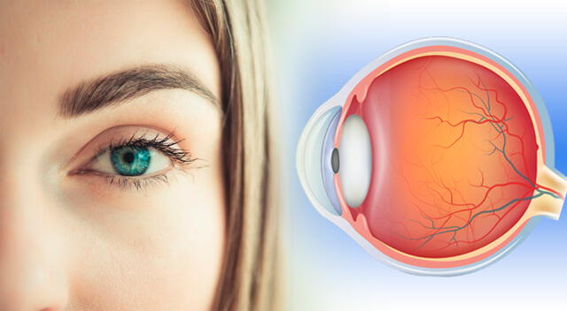 El colesterol alto puede afectar la visión al interferir con la circulación ocular y el procesamiento visual en el cerebro. El colesterol alto puede afectar la visión al interferir con la circulación ocular y el procesamiento visual en el cerebro.