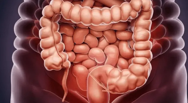 El cáncer de colon se origina en el revestimiento interno del intestino grueso, generalmente a partir de pequeños crecimientos llamados pólipos. El cáncer de colon se origina en el revestimiento interno del intestino grueso, generalmente a partir de pequeños crecimientos llamados pólipos.