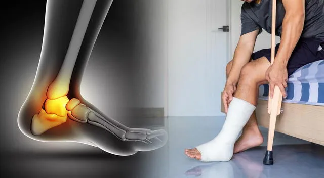 La fractura de peroné suele producirse tras una torcedura violenta del tobillo. La fractura de peroné suele producirse tras una torcedura violenta del tobillo.