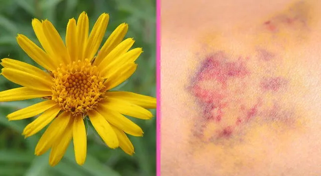 Árnica es reconocida por sus efectos antiinflamatorios. Árnica es reconocida por sus efectos antiinflamatorios.