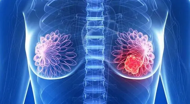 El hallazgo de la proteína TIM-3 podría cambiar la forma en que se combate la expansión del cáncer de mama en sus primeras etapas. El hallazgo de la proteína TIM-3 podría cambiar la forma en que se combate la expansión del cáncer de mama en sus primeras etapas.