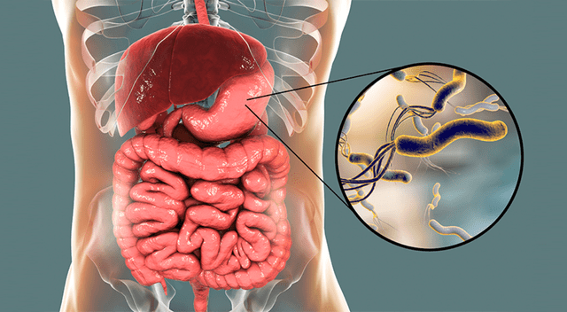 Expertos advierten que detectar la bacteria H. pylori a tiempo podría prevenir millones de casos de cáncer de estómago en todo el mundo. Expertos advierten que detectar la bacteria H. pylori a tiempo podría prevenir millones de casos de cáncer de estómago en todo el mundo.