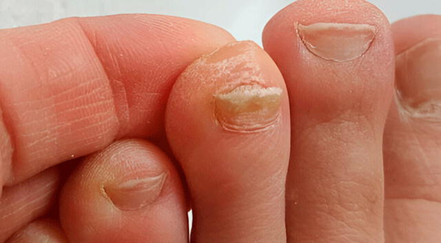 Tratamientos antifúngicos como lacas, geles o lápices ofrecen resultados más rápidos y efectivos cuando la infección ya está avanzada. Tratamientos antifúngicos como lacas, geles o lápices ofrecen resultados más rápidos y efectivos cuando la infección ya está avanzada.