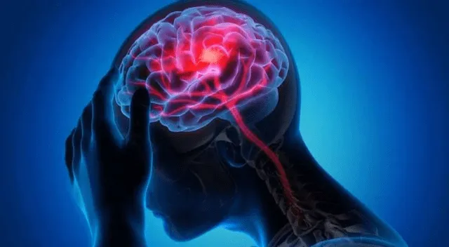 Uno de los grandes peligros del aneurisma cerebral es que puede no presentar síntomas hasta el momento en que se rompe.