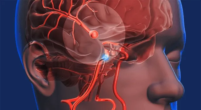 Existen diferentes formas de aneurismas cerebrales, pero el más común es el aneurisma sacciforme.