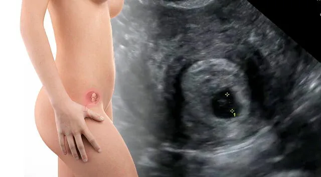 El duelo tras un aborto espontáneo es un proceso complejo que requiere apoyo y comprensión. 