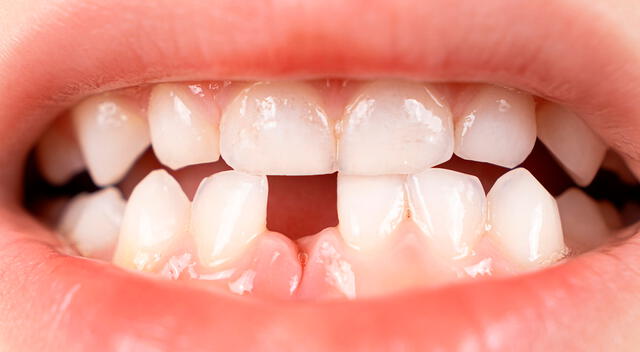 La medicina regenerativa abre la posibilidad de recuperar dientes naturales sin necesidad de implantes, marcando un cambio radical en el tratamiento dental. La medicina regenerativa abre la posibilidad de recuperar dientes naturales sin necesidad de implantes, marcando un cambio radical en el tratamiento dental.