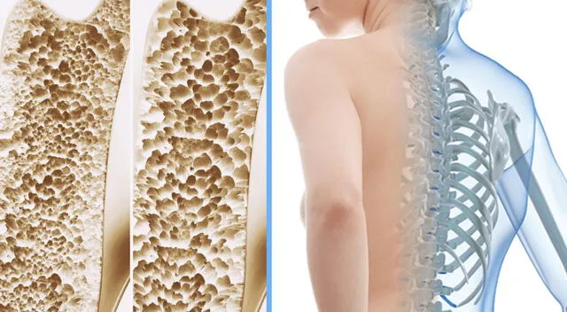 Osteoporosis Osteoporosis