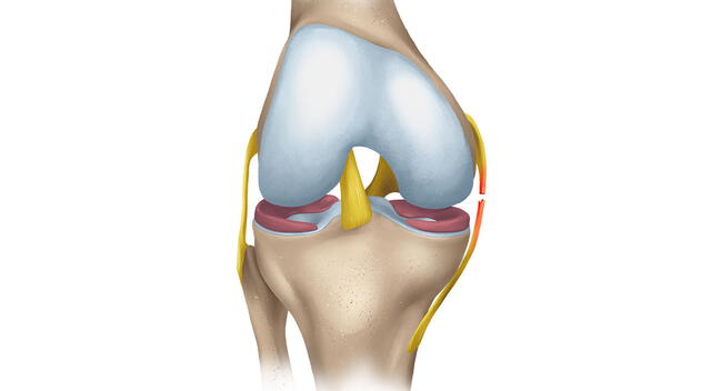 Rotura de ligamentos cruzados Rotura de ligamentos cruzados