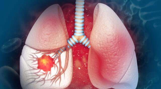 Cáncer de pulmón