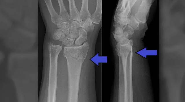 Fractura de radio distal Fractura de radio distal