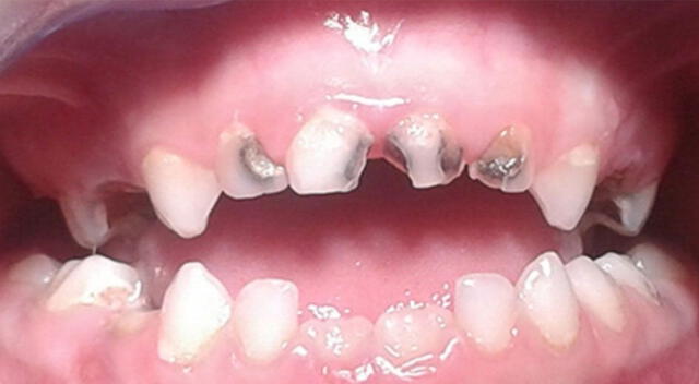Caries infantil