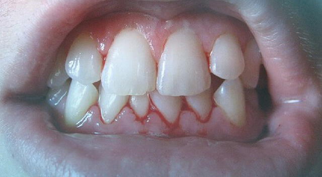 Gingivitis en niños