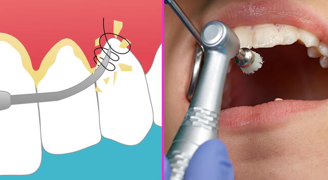 Profilaxis dental en niños