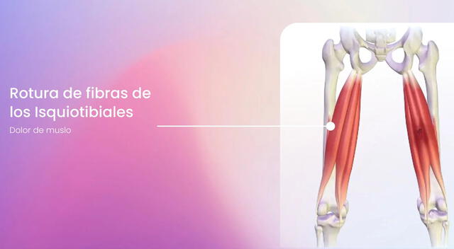 Rotura fibrilar Rotura fibrilar