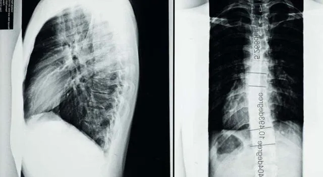 Fractura vertebral patológica Fractura vertebral patológica