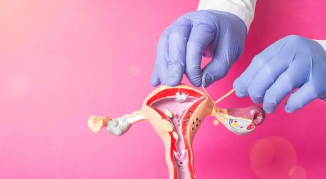 La ligadura de trompas es un método anticonceptivo permanente que muchas mujeres eligen por motivos médicos o personales. La ligadura de trompas es un método anticonceptivo permanente que muchas mujeres eligen por motivos médicos o personales.