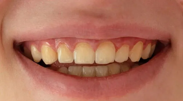 Dientes amarillos
