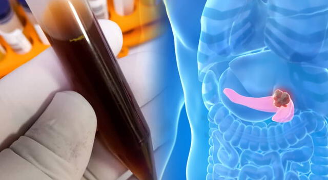 La orina oscura puede ser un síntoma temprano del cáncer de páncreas, por lo que es importante prestar atención a cualquier cambio en su color.